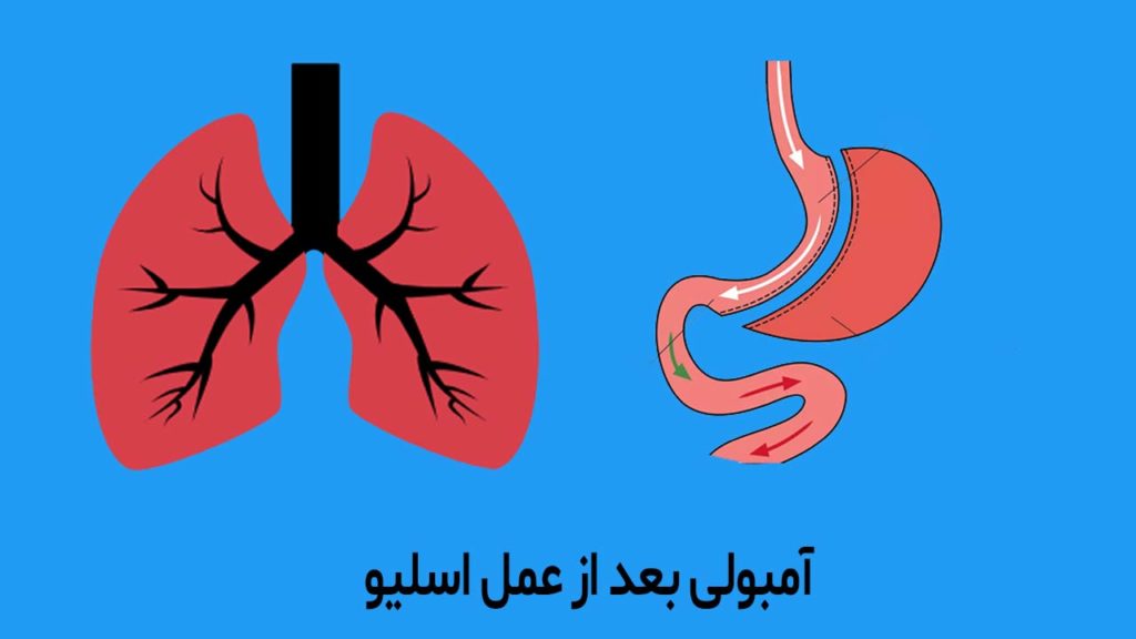 آمبولی بعد از عمل اسلیو معده: علائم هشداردهنده‌ای که باید بشناسید