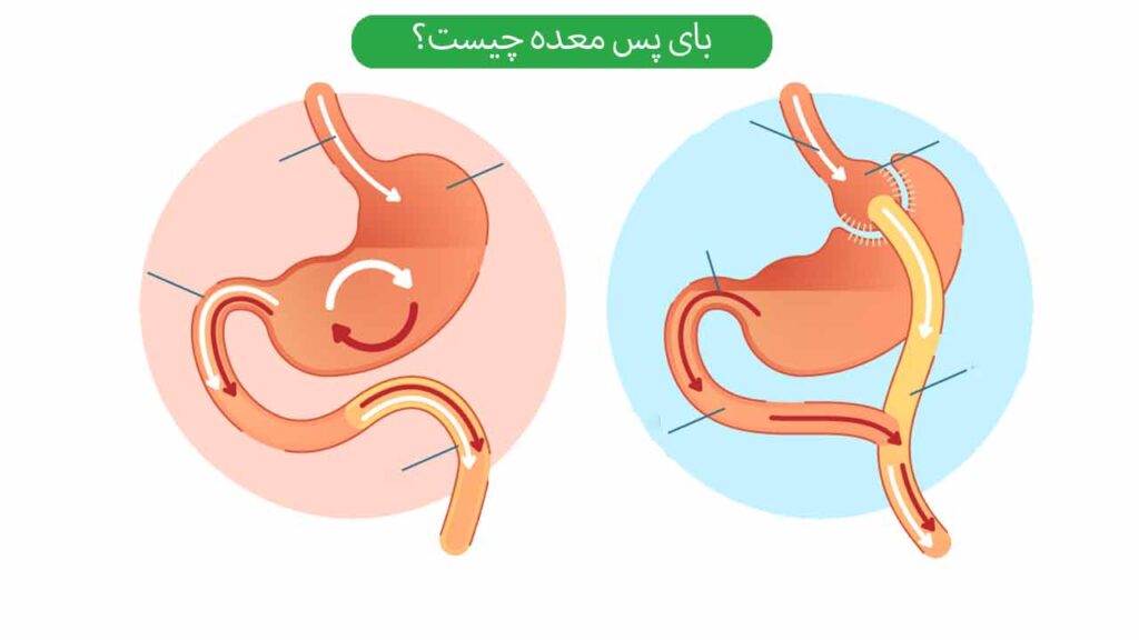 بای پس معده چیست؟