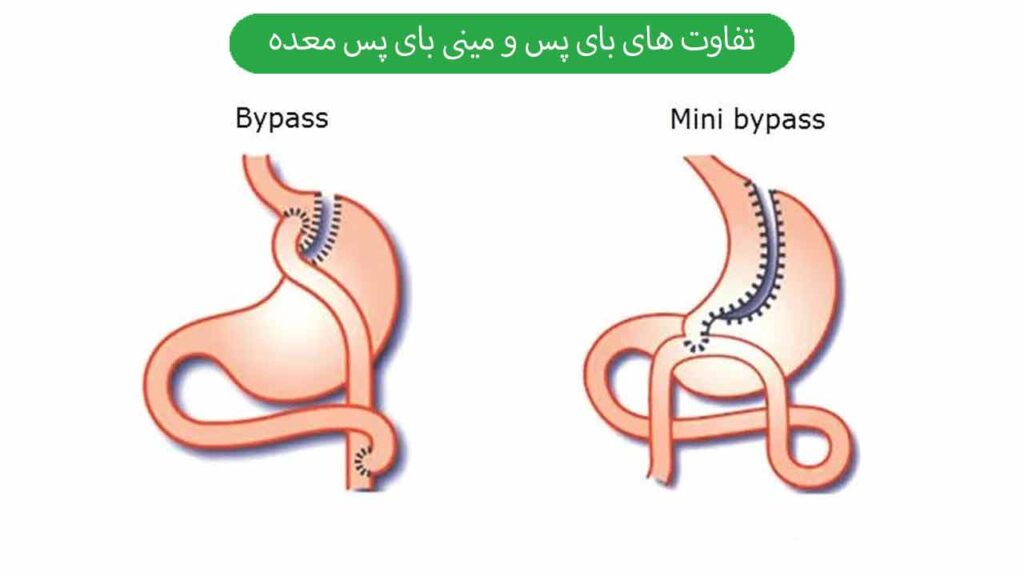 تفاوت های بای پس و مینی بای پس معده