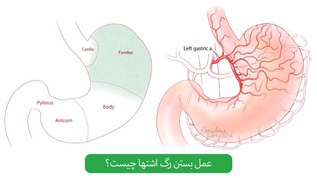 عمل بستن رگ اشتها چیست؟