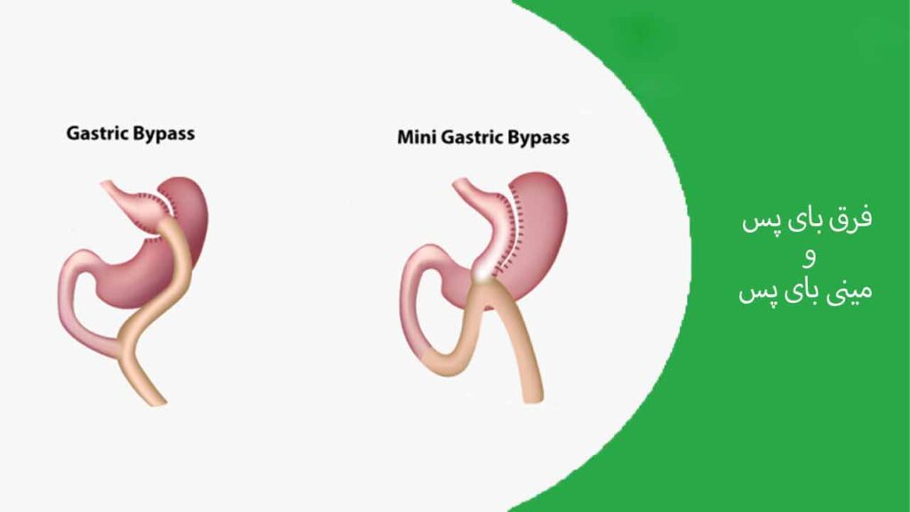 فرق بای پس و مینی بای پس