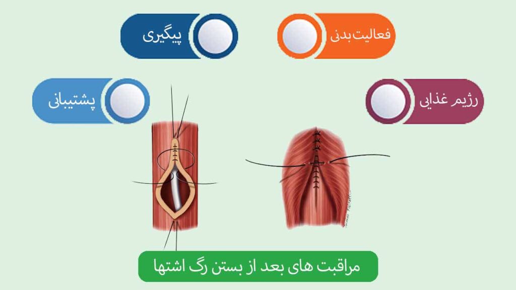 مراقبت های بعد از بستن رگ اشتها