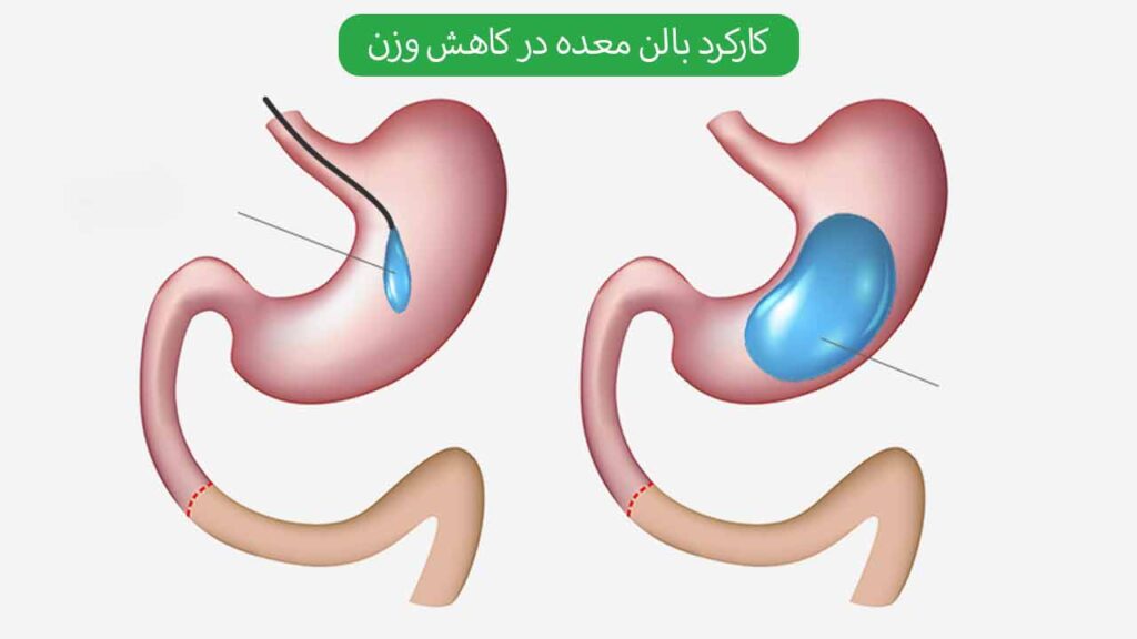 کارکرد بالن معده در کاهش وزن