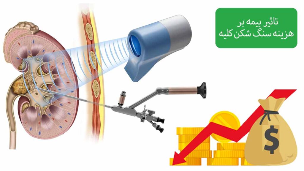 تاثیر بیمه بر هزینه سنگ شکن کلیه