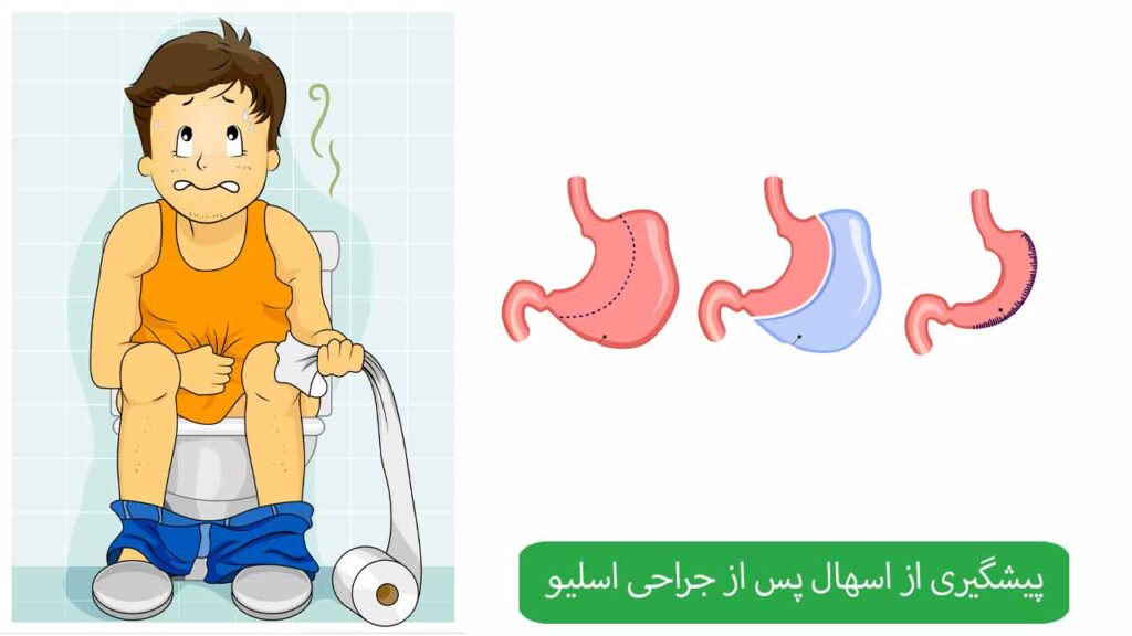 پیشگیری از اسهال پس از جراحی اسلیو