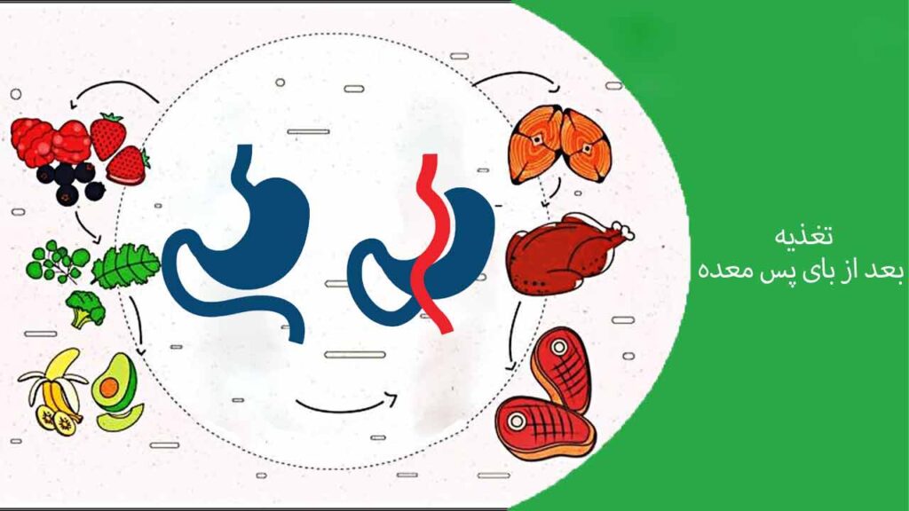 تغذیه بعد از بای پس معده