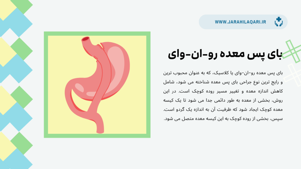 بای پس معده رو-ان-وای