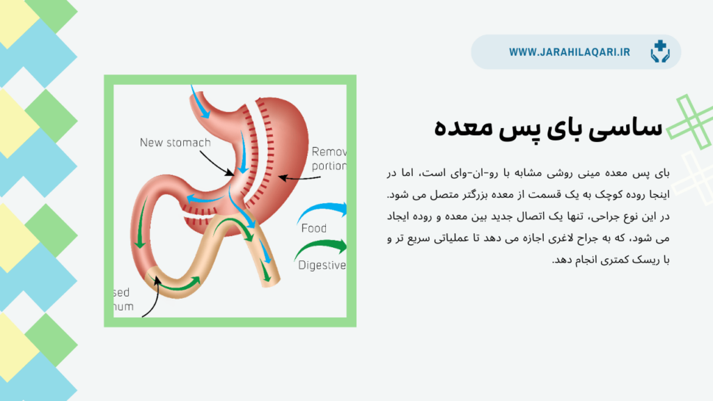 ساسی بای پس معده