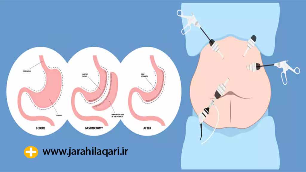 آشنایی با جراحی اسلیو معده